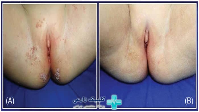 تصویر واقعی از زگیل های تناسلی در کودکان