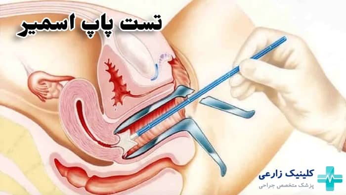 تصویر از نحوه انجام تست پاپ اسمیر واژن و دهانه رحم