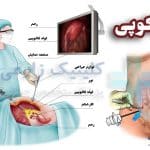 لاپاراسکوپی روده چیست | نحوه عمل، هزینه + مدت زمان و عوارض