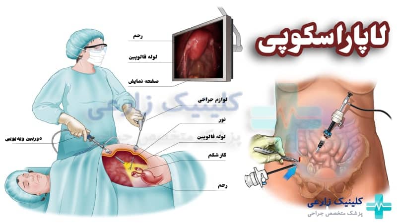 لاپاراسکوپی یا لاپاروسکوپی چیست و چگونه انجام می شود؟