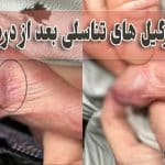 عود زگیل تناسلی به چه علت است؟ چگونه جلوگیری کنیم؟
