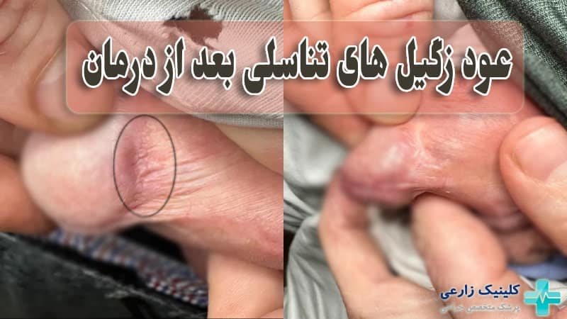 عود زگیل تناسلی به چه علت است؟ چگونه جلوگیری کنیم؟