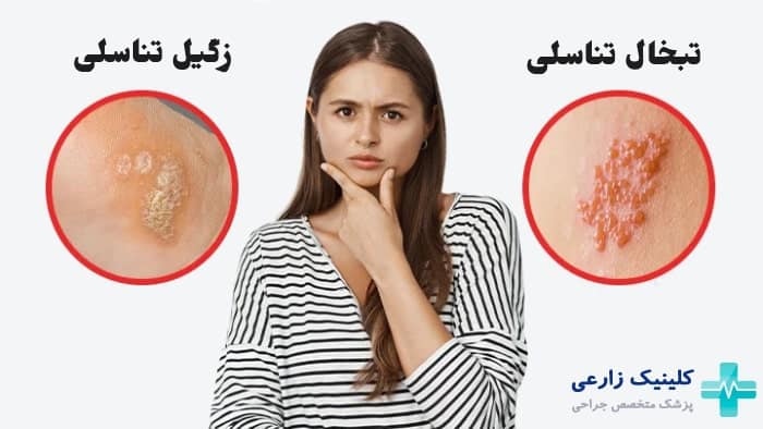 عکس تفاوت های زگیل تناسلی با تبخال