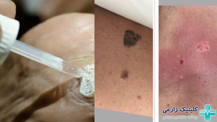 عوارض اسید سالیسیلیک
