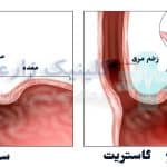 گاستریت (التهاب معده) چیست| عوارض خطرناک، علائم +‌ درمان قطعی