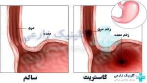 گاستریت (التهاب معده) چیست| عوارض خطرناک، علائم +‌ درمان قطعی