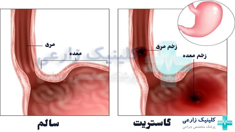 گاستریت (التهاب معده) چیست| عوارض خطرناک، علائم +‌ درمان قطعی