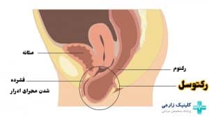 رکتوسل چیست | علائم، درمان بیرون زدگی روده از واژن + عوارض