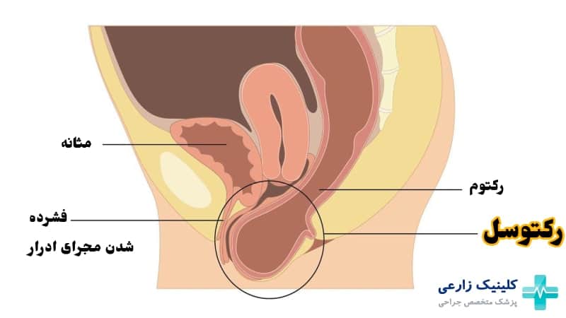 رکتوسل چیست | علائم، درمان بیرون زدگی روده از واژن + عوارض
