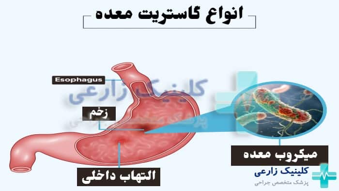تصویر التهاب معده مزمن