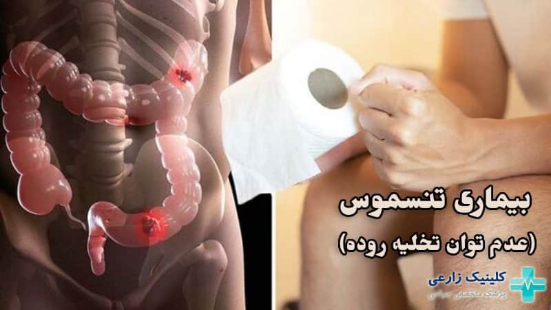 تنسموس چیست | روشهای درمان + علائم Tenesmus و پیشگیری
