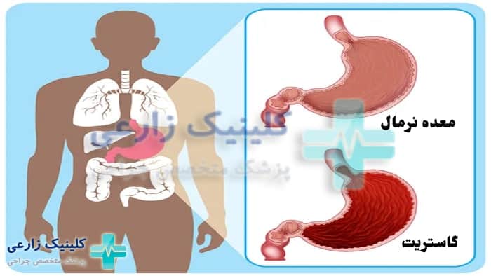 عکس گاستریت معده چیست
