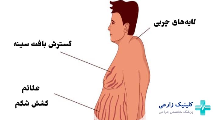 عکس علائم سندرم کوشینگ