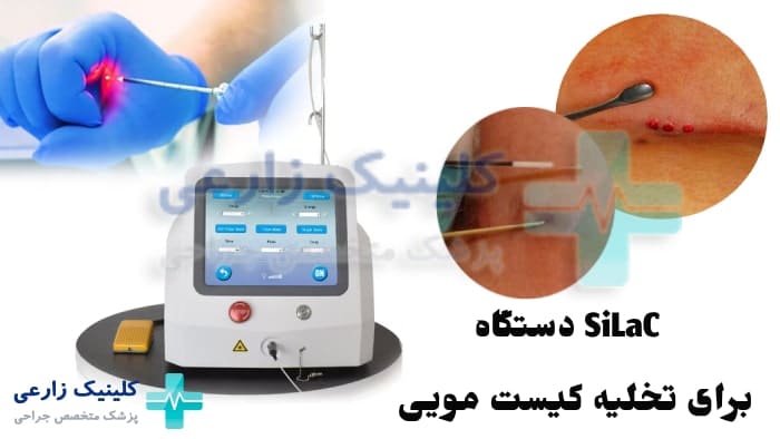 عکس دستگاه SiLaC جدید برای تخلیه کیست مویی کمر