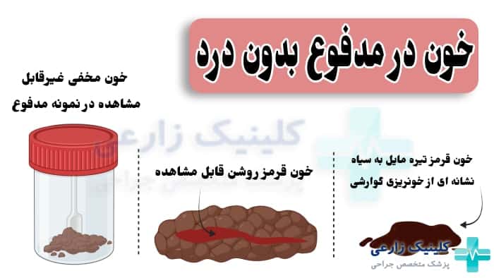 عکس از خون در مدفوع بدون درد نشانه