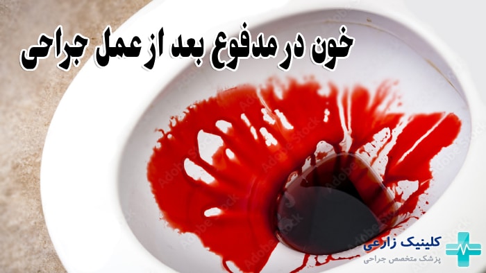علت مدفوع خونی بعد از جراحی چیست