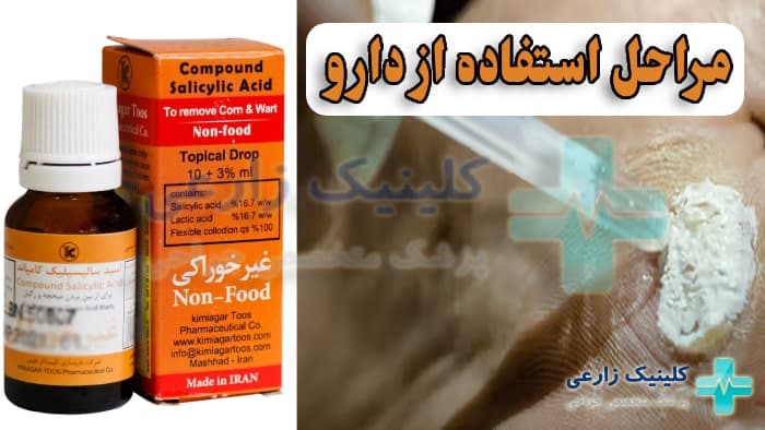 نحوه استفاده از محلول و پماد اسید سالیسیلیک برای زگیل