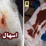 اسهال خونی (دیسانتری) نشانه چیست | +5 علت، خطرات و درمان