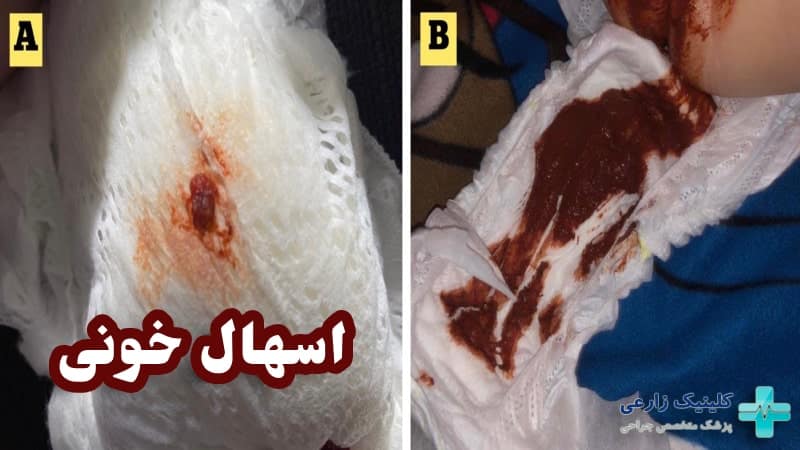 اسهال خونی (دیسانتری) نشانه چیست | +5 علت، خطرات و درمان