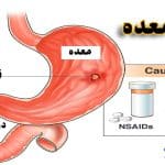 علائم زخم معده چیست | درمان، بهترین قرص، دارو و تشخیص