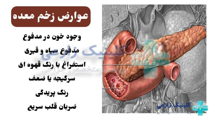 عکس از عوارض زخم معده در بزرگسالان و کودکان
