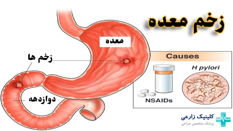 علائم زخم معده چیست | درمان، بهترین قرص، دارو و تشخیص