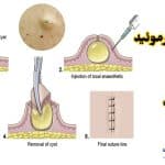 کیست اپیدرموئید (اپیدرمال) چیست | تفاوت با کیست مویی + درمان