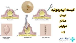 کیست اپیدرموئید (اپیدرمال) چیست | تفاوت با کیست مویی + درمان