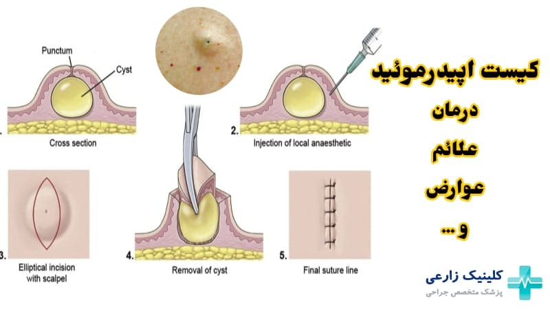 کیست اپیدرموئید (اپیدرمال) چیست | تفاوت با کیست مویی + درمان