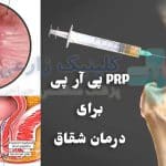 PRP برای درمان شقاق مقعدی | نحوه انجام، عوارض