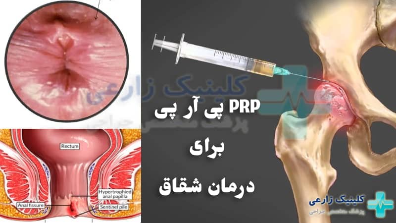 PRP برای درمان شقاق مقعدی | نحوه انجام، عوارض