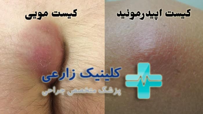 عکس تفاوت کیست مویی با کیست اپیدرموئید