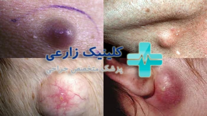 عکس انواع کیست اپیدرمال صورت و گردن