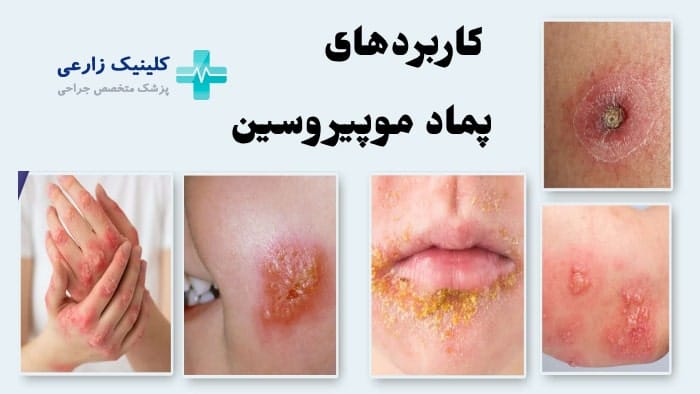 عکس کاربرد های پماد موپیروسین