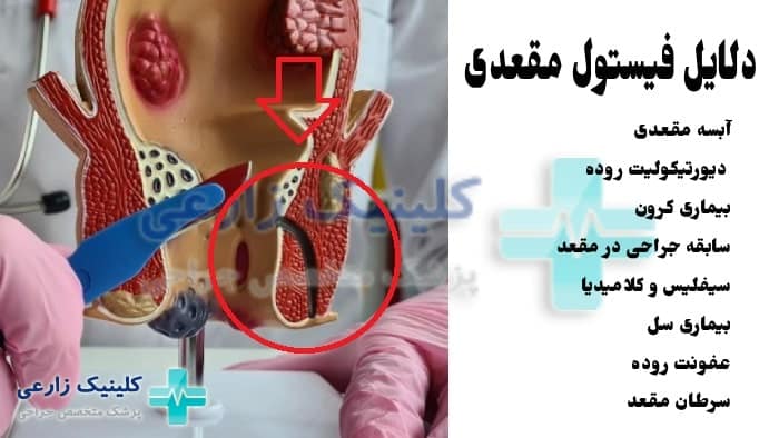 عکس دلایل فیستول مقعدی