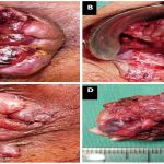 بواسیر عفونی | +8 علائم عفونت هموروئید + درمان خانگی