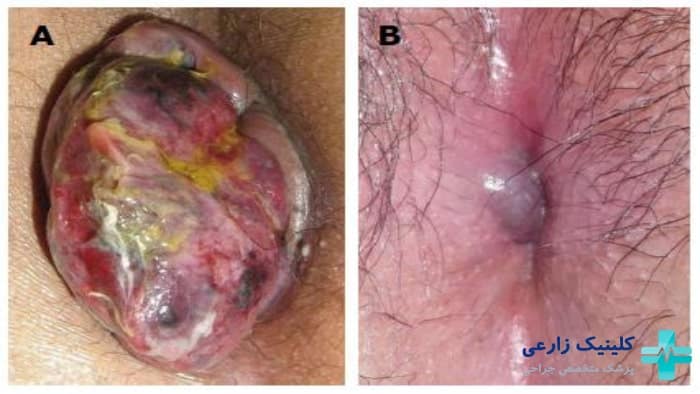 عکس دلایل عفونت کردن بواسیر