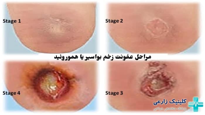 برای عفونت هموروئید چه کنیم + عکس عفونت هموروئید