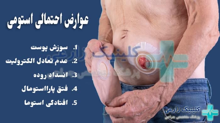 عکس عوارض و خطرات استومی