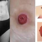 بیماری استومی Ostomy چیست | انواع، روش عمل و عوارض + طول عمر