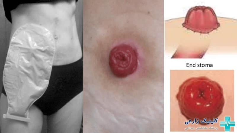 بیماری استومی Ostomy چیست | انواع، روش عمل و عوارض + طول عمر