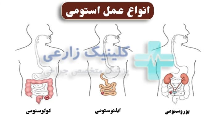 عکس انواع عمل استومی