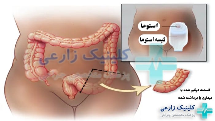 عکس محل قرارگیری کیسه استوما
