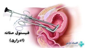 فیستول مثانه (ادراری) | علائم، دلایل، خطرات و روشهای درمان