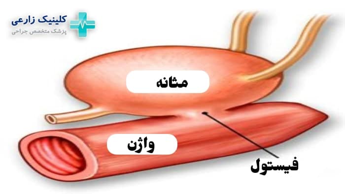 عکس علت به وجود آمدن فیستول ادراری
