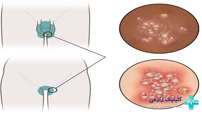 عکس زگیل تناسلی نوع ۱۸