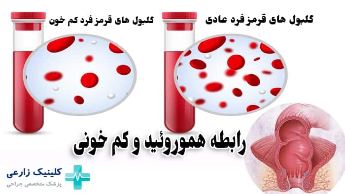 رابطه کم خونی و بواسیر