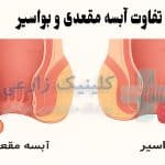 تفاوت آبسه مقعدی و بواسیر (هموروئید) | 5 روش تشخیص فوری
