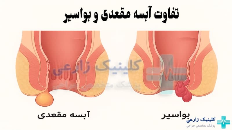 تفاوت آبسه مقعدی و بواسیر (هموروئید) | 5 روش تشخیص فوری