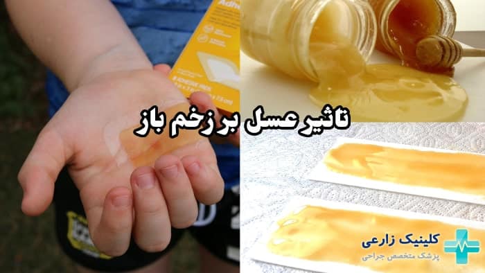شکل تاثیر استفاده از عسل برای درمان زخم باز